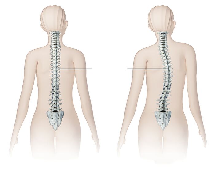 boala coloanei vertebrale osteocondroza