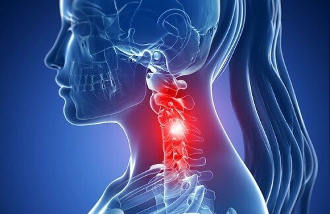 Osteocondroza coloanei vertebrale cervicale: tratament și consecințe