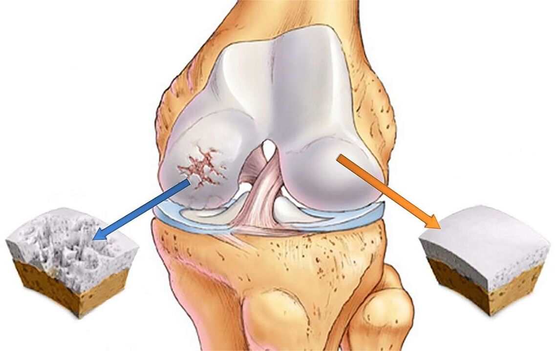 Distrugerea cartilajului articulației genunchiului cu gonartroză