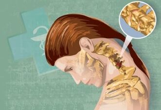 Simptome reflexe ale osteochondrozei cervicale