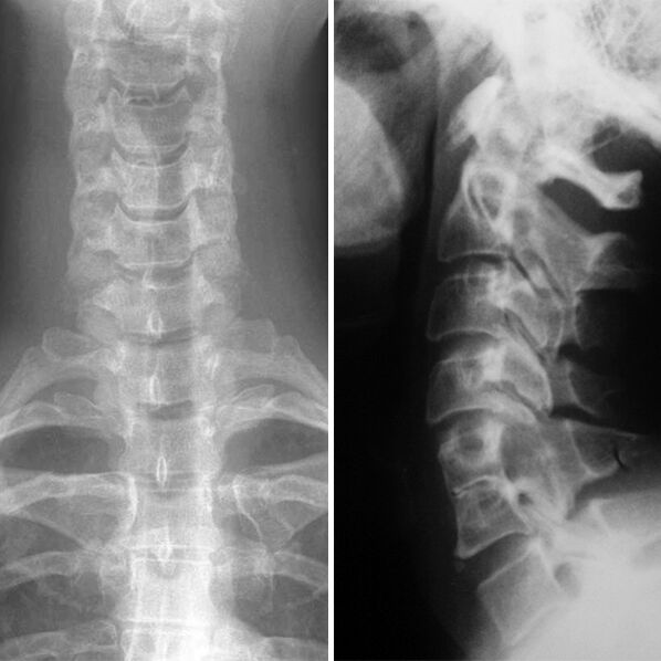 Radiografia coloanei cervicale